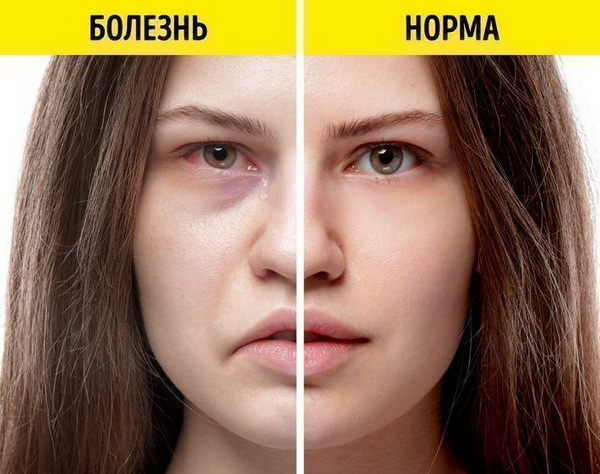 7 признаков заболевания, которые можно узнать по лицу